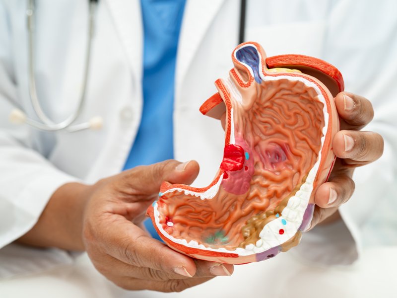 Gastric-Cancer-Hirschfeld-Oncology