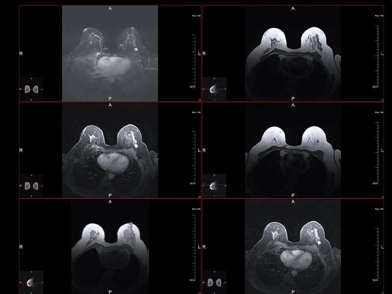 Hirschfeld-Oncology-Breast-Cancer-Chemotherapy Hirschfeld-Oncology-Breast-Cancer-Chemotherapy
