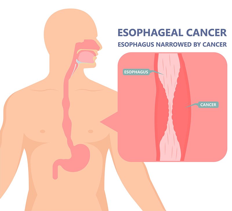 Narrowing-of-Esophagus-due-to-Cancer Narrowing-of-Esophagus-due-to-Cancer